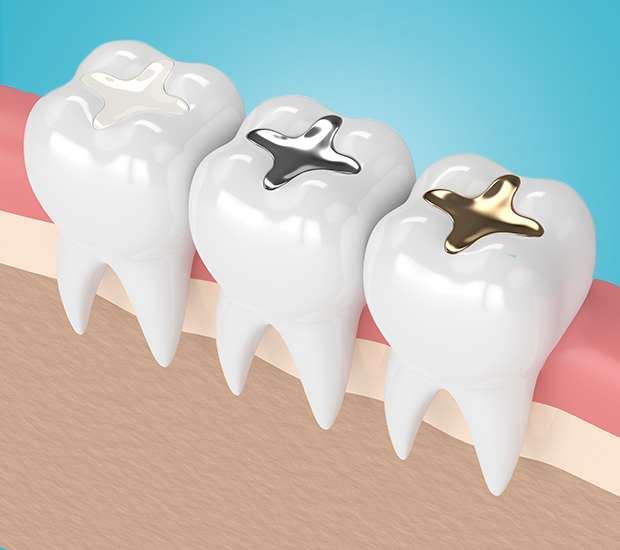 Vienna Composite Fillings