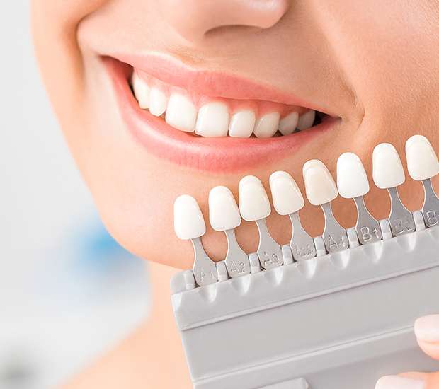 Vienna Dental Veneers and Dental Laminates