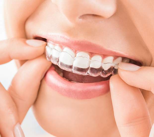 Vienna Does Invisalign Really Work